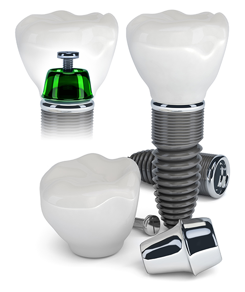 Brooklyn dental implant