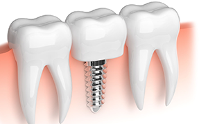 Dental Implants in Glenwood