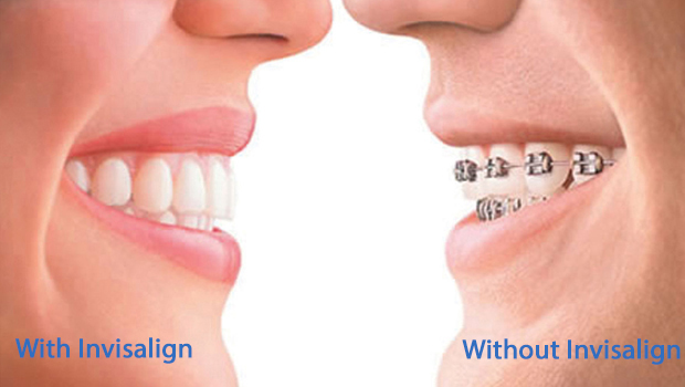 invisalign in Brooklyn